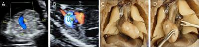 Prenatal transposition of great arteries diagnosis and management: a Chinese single-center study